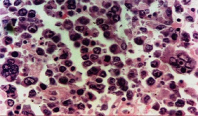 Fig. 9: Caso de IPSID, células bizarras. - <div style=